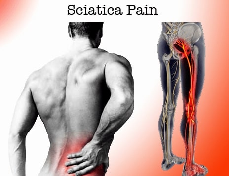 Sciatic Nerve Path - Ace Physiotherapy Center Hyderabad